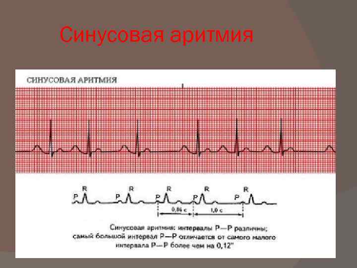 Синусовая аритмия что. Синусовая аритмия на ЭКГ. Что такое синусовая аритмия сердца у взрослого на ЭКГ. ЭКГ при синусовой аритмии. Синусовая аритмия сердца на ЭКГ У ребенка.