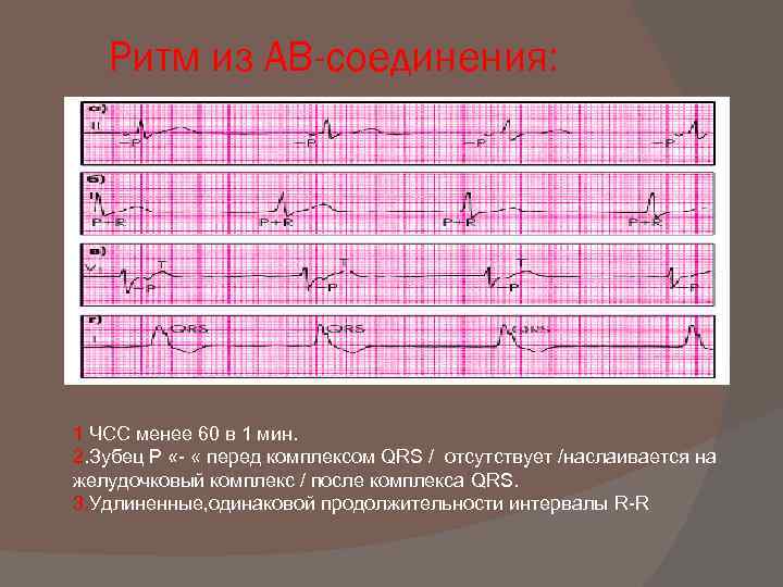 Ритм из АВ-соединения: 1 ЧСС менее 60 в 1 мин. 2. Зубец Р «-