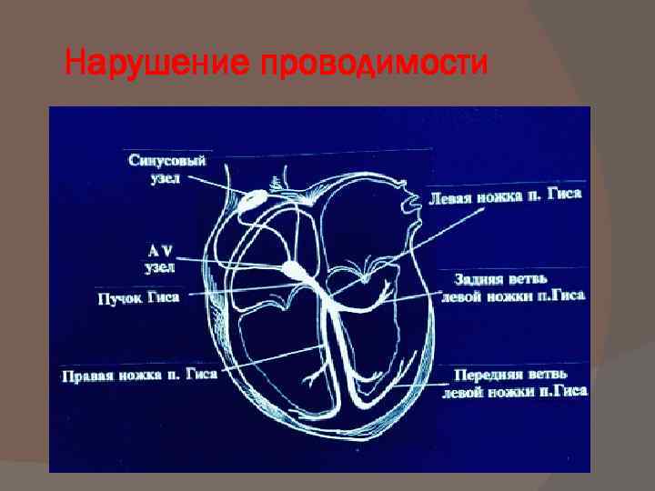 Нарушение проводимости сердца