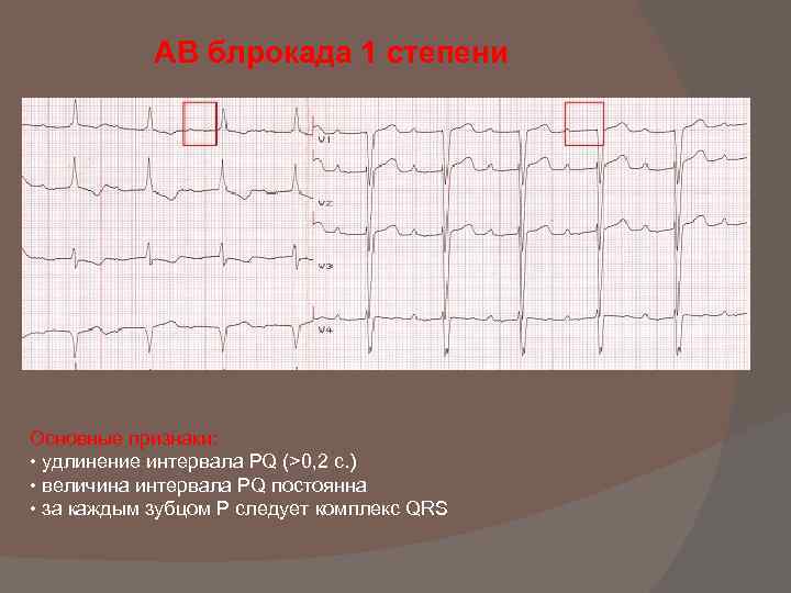 АВ блрокада 1 степени Основные признаки: • удлинение интервала PQ (>0, 2 с. )