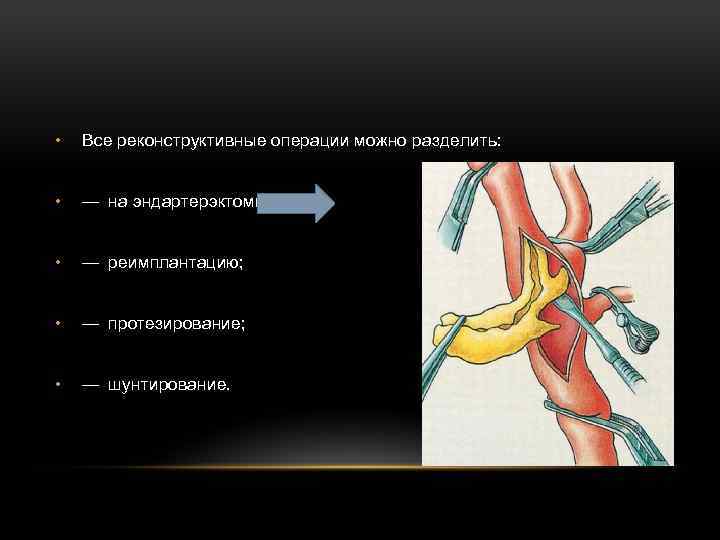  • Все реконструктивные операции можно разделить: • — на эндартерэктомию • — реимплантацию; • — протезирование;