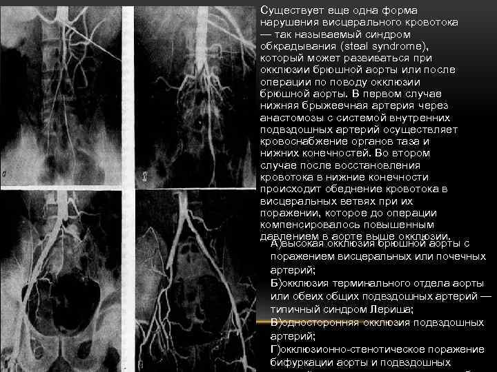  • Существует еще одна форма нарушения висцерального кровотока — так называемый синдром обкрадывания