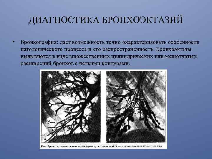 ДИАГНОСТИКА БРОНХОЭКТАЗИЙ • Бронхография: дает возможность точно охарактеризовать особенности патологического процесса и его распространенность.