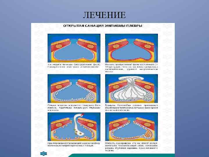 Гнойные заболевания легких и плевры презентация