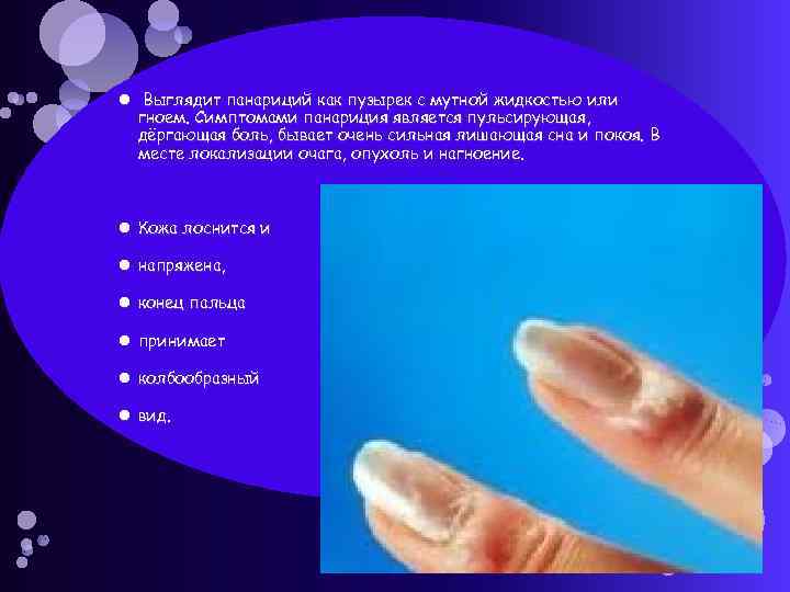  Выглядит панариций как пузырек с мутной жидкостью или гноем. Симптомами панариция является пульсирующая,