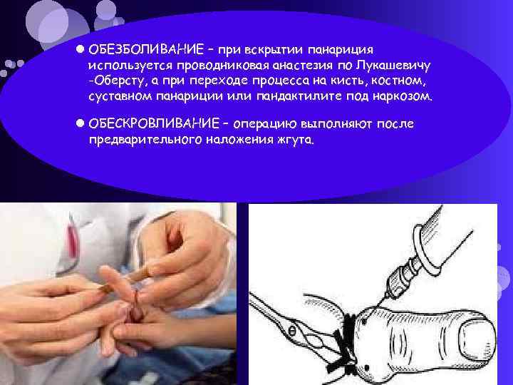  ОБЕЗБОЛИВАНИЕ – при вскрытии панариция используется проводниковая анастезия по Лукашевичу -Оберсту, а при