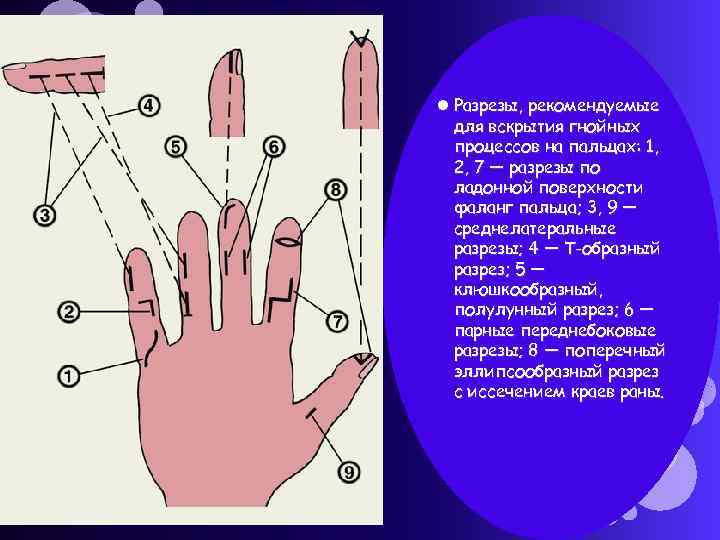  Разрезы, рекомендуемые для вскрытия гнойных процессов на пальцах: 1, 2, 7 — разрезы