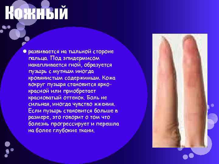  Кожный развивается на тыльной стороне пальца. Под эпидермисом накапливается гной, образуется пузырь с