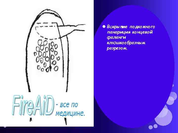  Вскрытие подкожного панариция концевой фаланги клюшкообразным разрезом. 