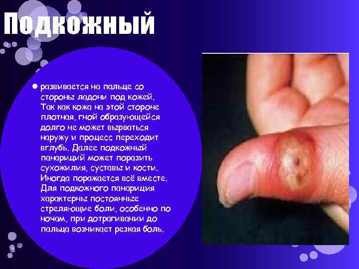 Подкожный развивается на пальце со стороны ладони под кожей. Так кожа на этой стороне