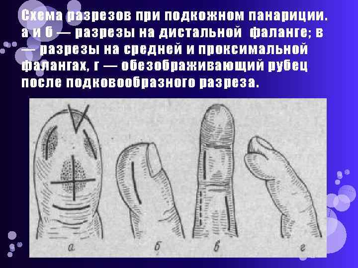 Схема разрезов при подкожном панариции. а и б — разрезы на дистальной фаланге; в