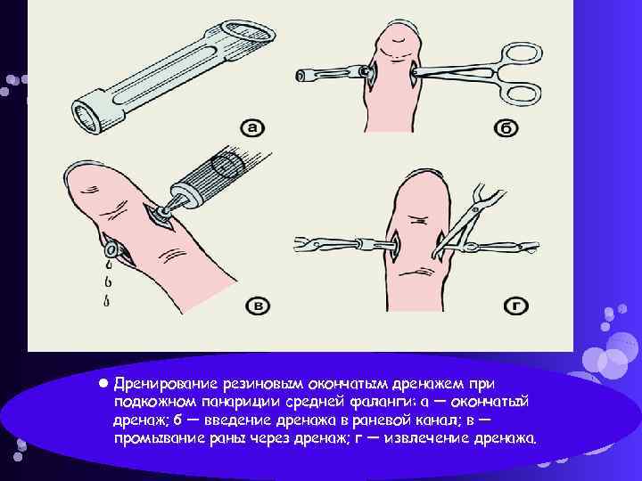  Дренирование резиновым окончатым дренажем при подкожном панариции средней фаланги: а — окончатый дренаж;