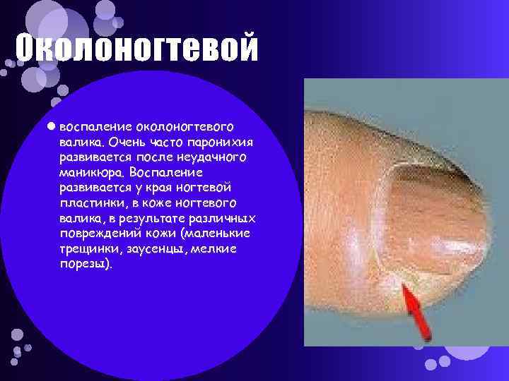 Околоногтевой воспаление околоногтевого валика. Очень часто паронихия развивается после неудачного маникюра. Воспаление развивается у