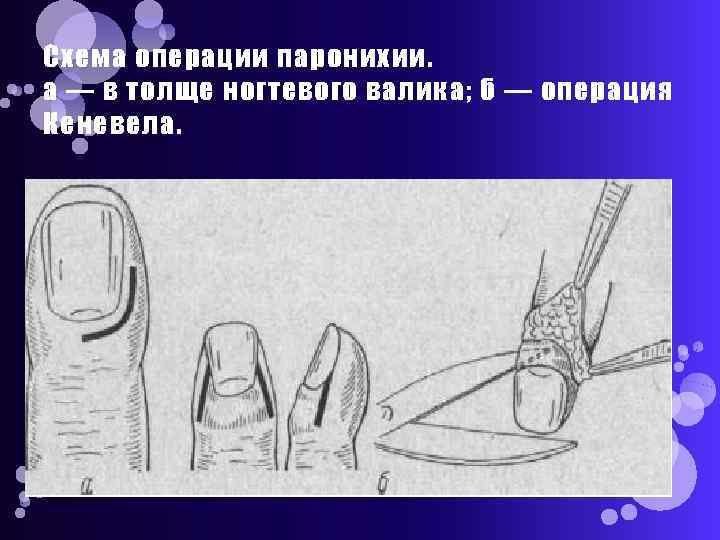 Схема операции паронихии. а — в толще ногтевого валика; б — операция Кеневела. 