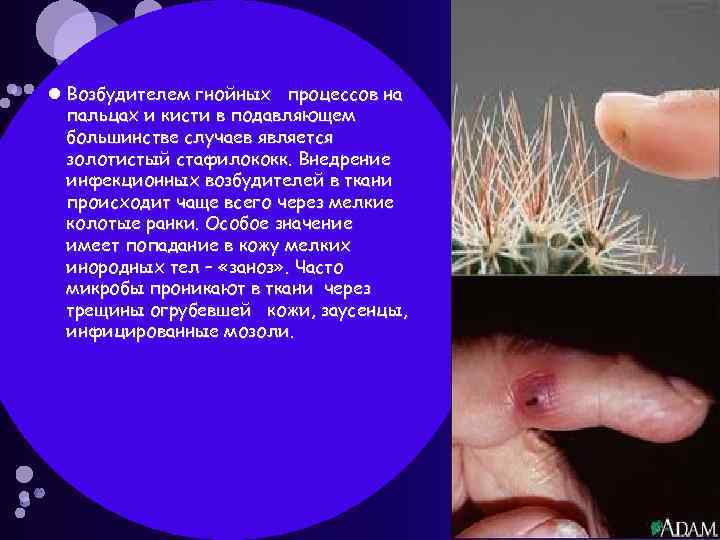  Возбудителем гнойных процессов на пальцах и кисти в подавляющем большинстве случаев является золотистый