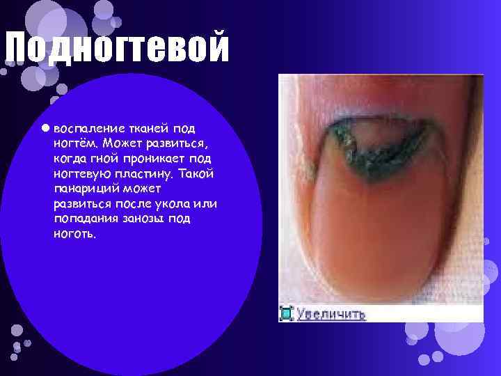 Подногтевой воспаление тканей под ногтём. Может развиться, когда гной проникает под ногтевую пластину. Такой