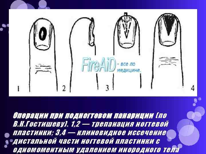 Операции при подногтевом панариции (по В. К. Гостишеву). 1, 2 — трепанация ногтевой пластинки;