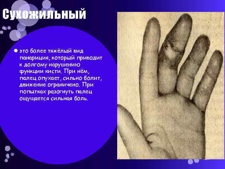 Сухожильный это более тяжёлый вид панариция, который приводит к долгому нарушению функции кисти. При