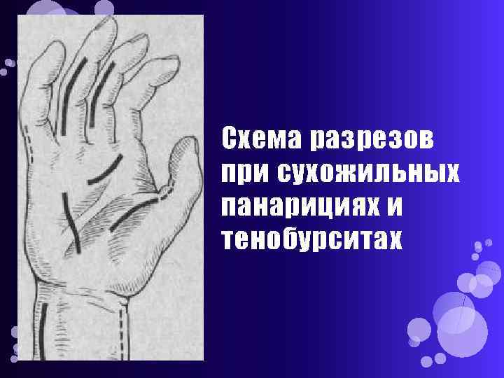 Схема разрезов при сухожильных панарициях и тенобурситах 