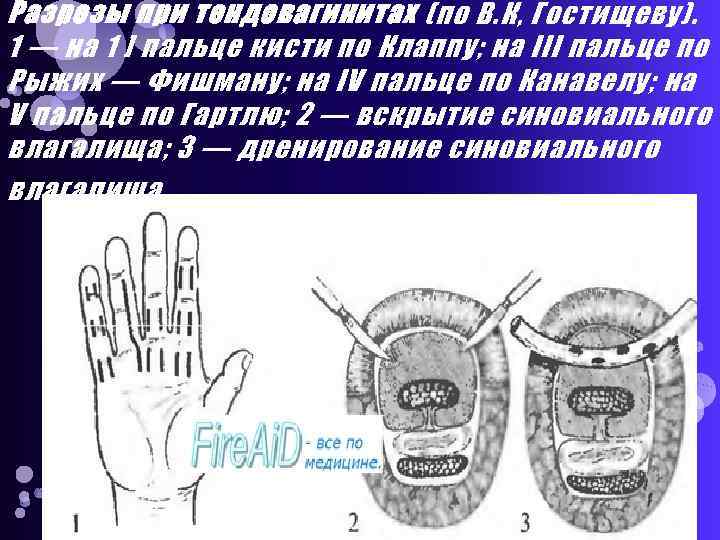 Разрезы при тендовагинитах (по В. К, Гостищеву). 1 — на 1 ] пальце кисти