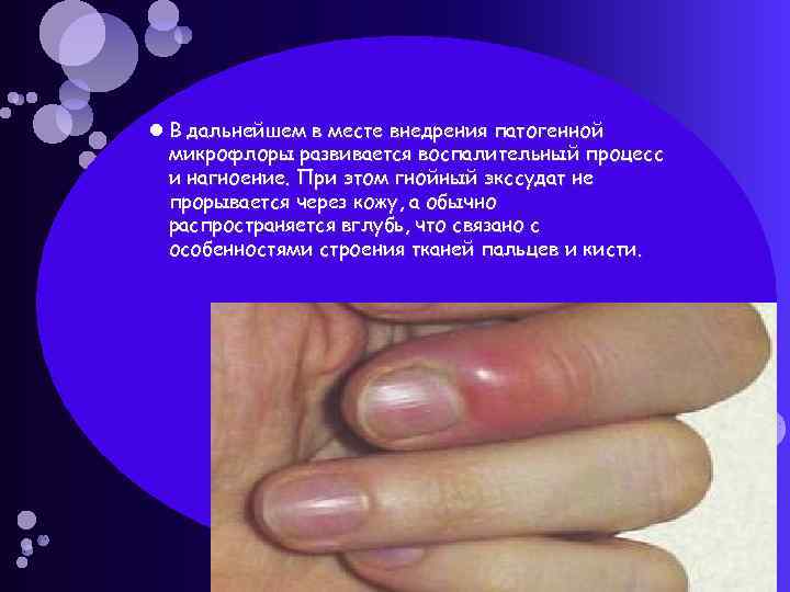  В дальнейшем в месте внедрения патогенной микрофлоры развивается воспалительный процесс и нагноение. При