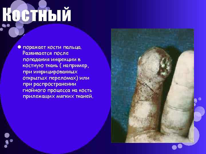 Костный поражает кости пальца. Развивается после попадания инфекции в костную ткань ( например, при
