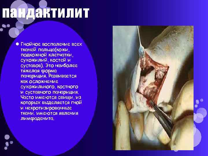 пандактилит Гнойное воспаление всех тканей пальца(кожи, подкожной клетчатки, сухожилий, костей и суставов). Это наиболее