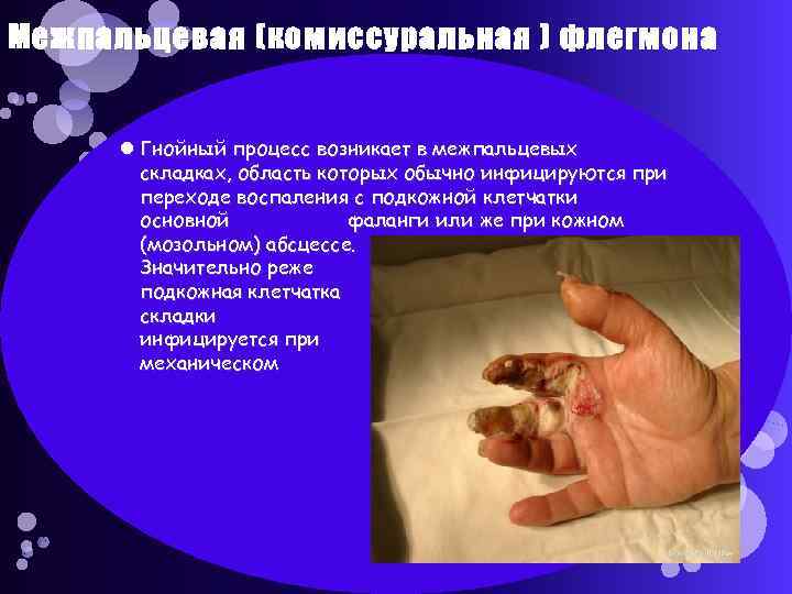 Межпальцевая (комиссуральная ) флегмона Гнойный процесс возникает в межпальцевых складках, область которых обычно инфицируются
