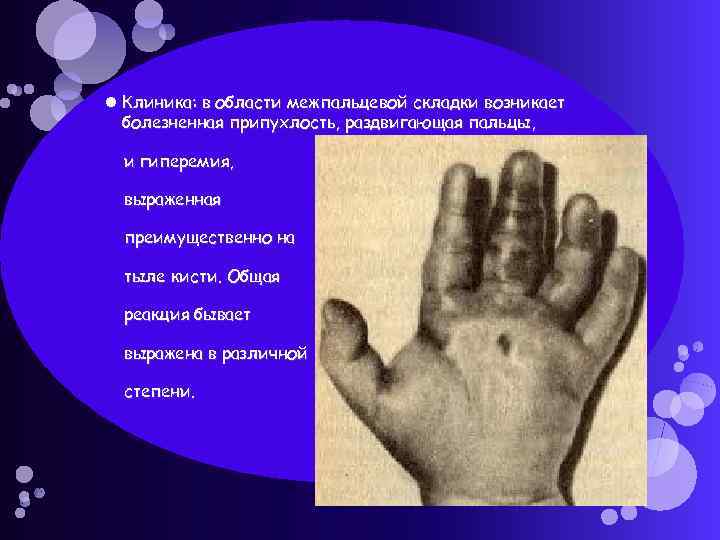  Клиника: в области межпальцевой складки возникает болезненная припухлость, раздвигающая пальцы, и гиперемия, выраженная