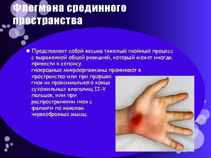 Флегмона срединного пространства Представляет собой весьма тяжелый гнойный процесс с выраженной общей реакцией, который