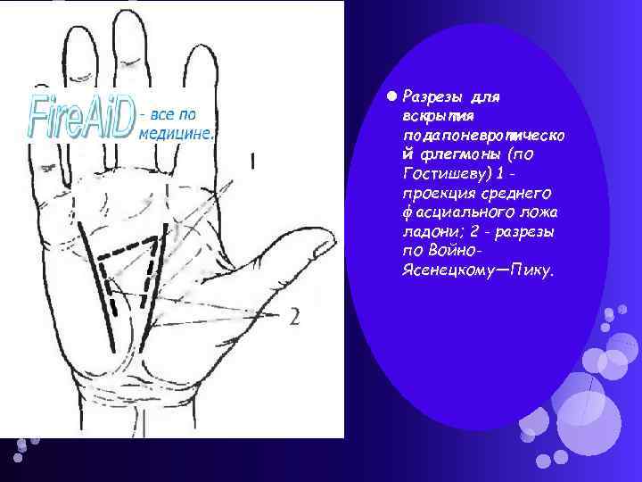 Разрезы для вскрытия подапоневротическо й флегмоны (по Гостишеву) 1 проекция среднего фасциального ложа
