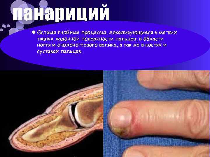 панариций Острые гнойные процессы, локализующиеся в мягких тканях ладонной поверхности пальцев, в области ногтя