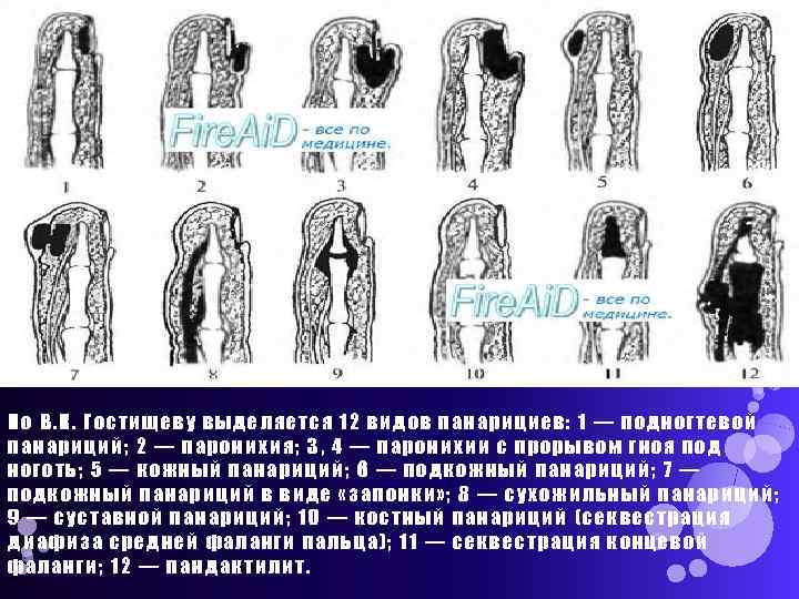 По В. К. Гостищеву выделяется 12 видов панарициев: 1 — подногтевой панариций; 2 —
