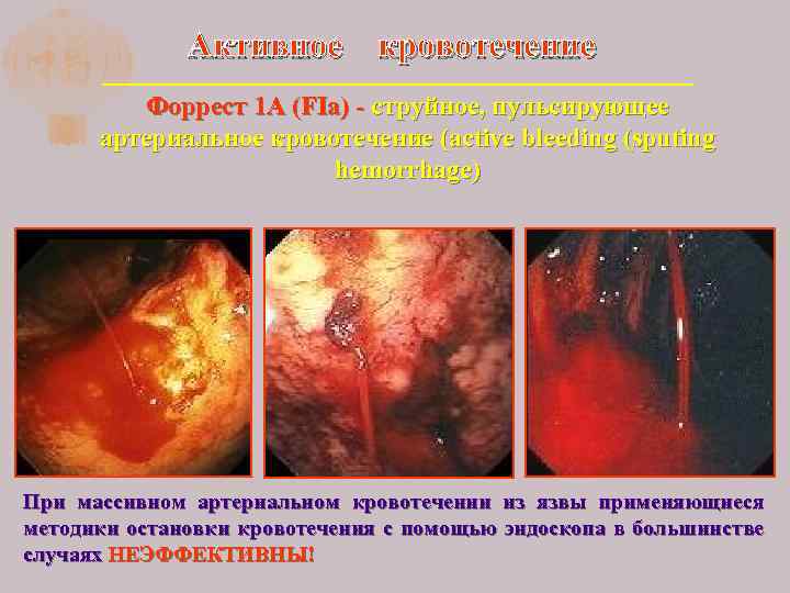 Активное кровотечение Форрест 1 А (FIa) - струйное, пульсирующее артериальное кровотечение (active bleeding (sputing