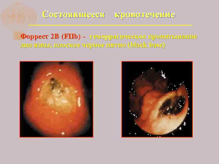 Состоявшееся кровотечение Форрест 2 В (FIIb) - геморрагическое пропитывание дна язвы, плоское черное пятно