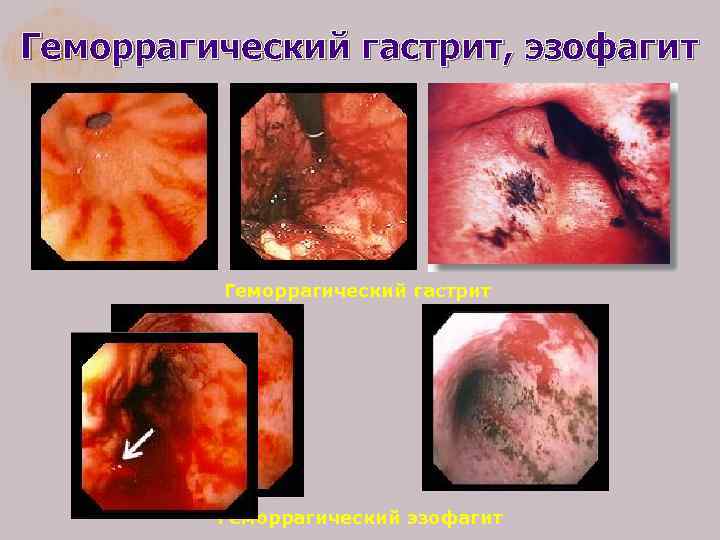 Геморрагический гастрит, эзофагит Геморрагический гастрит Геморрагический эзофагит 