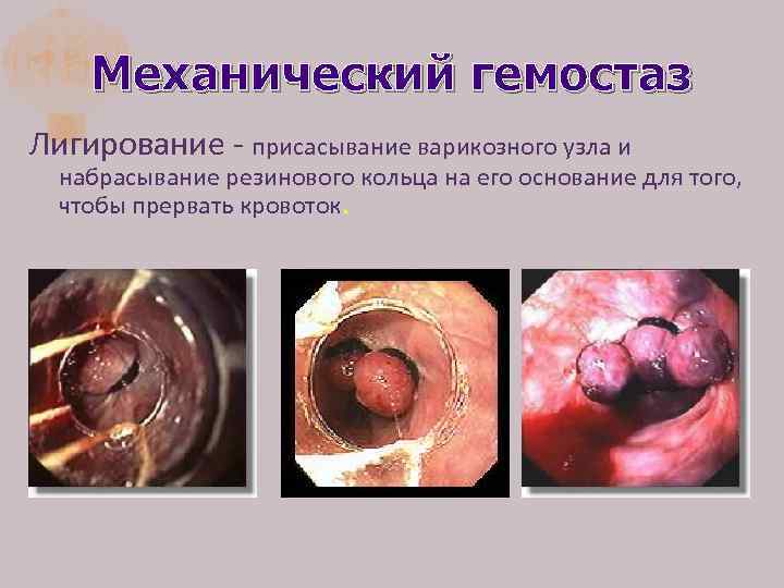 Механический гемостаз Лигирование - присасывание варикозного узла и набрасывание резинового кольца на его основание