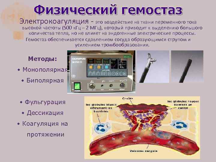 Физический гемостаз Электрокоагуляция - это воздействие на ткани переменного тока высокой частоты (500 к.