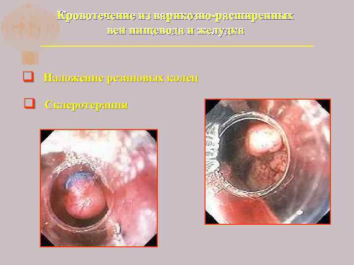 Кровотечение из варикозно-расширенных вен пищевода и желудка q Наложение резиновых колец q Склеротерапия 
