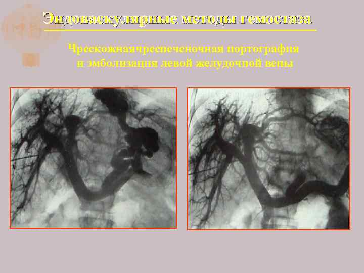 Эндоваскулярные методы гемостаза Чрескожнаячреспеченочная портография и эмболизация левой желудочной вены 