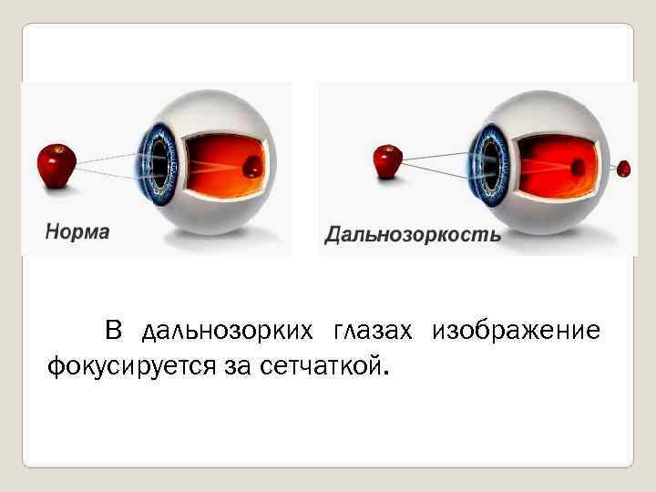 Изображение предметов фокусирующихся перед сетчаткой