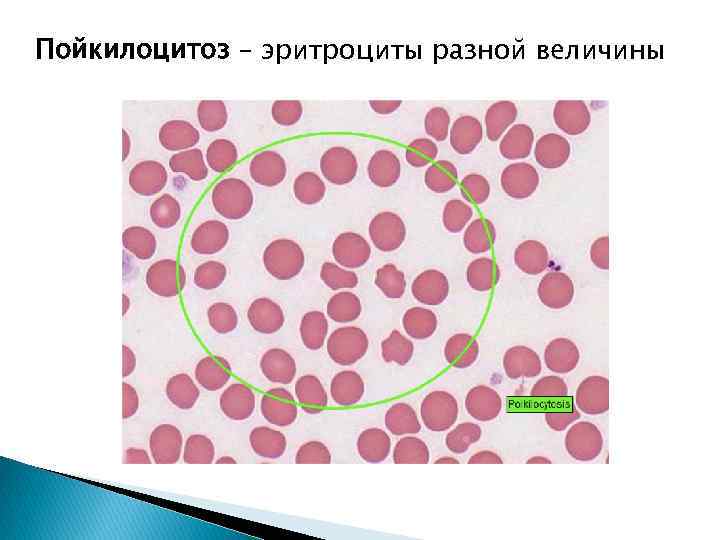 На рисунке изображены эритроциты. Анизо и пойкилоцитоз. Пойкилоцитоз эритроцитов. Патологический пойкилоцитоз. Пойкилоцитоз измененные эритроциты.