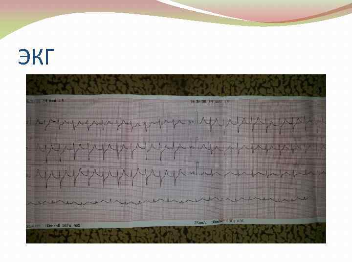 ЭКГ 