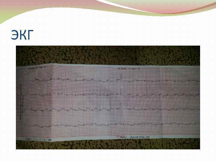 ЭКГ 