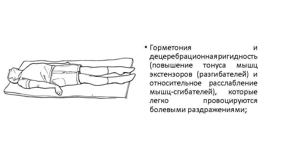  • Горметония и децеребрационная ригидность (повышение тонуса мышц экстензоров (разгибателей) и относительное расслабление