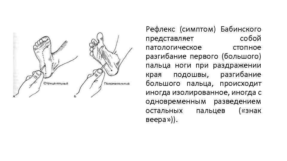 Рефлекс (симптом) Бабинского представляет собой патологическое стопное разгибание первого (большого) пальца ноги при раздражении