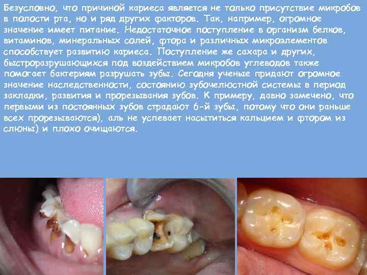 Безусловно, что причиной кариеса является не только присутствие микробов в полости рта, но и