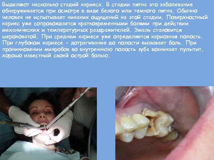 Выделяют несколько стадий кариеса. В стадии пятна это заболевание обнаруживается при осмотре в виде