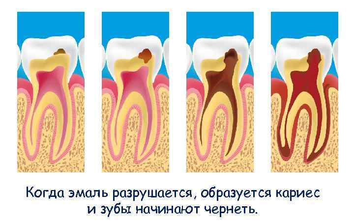 Когда эмаль разрушается, образуется кариес и зубы начинают чернеть. 