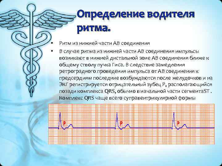 Определение водителя ритма. • • Ритм из нижней части АВ соединения В случае ритма